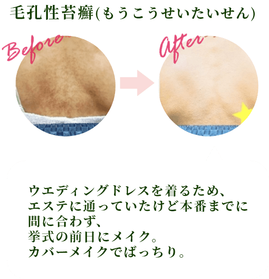 毛孔性苔癬（もうこうせいたいせん）