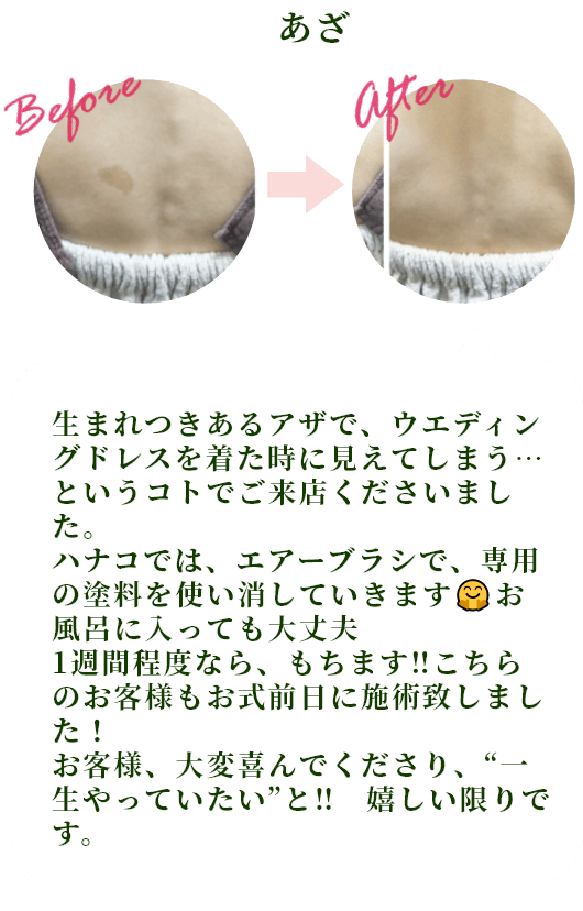 あざ